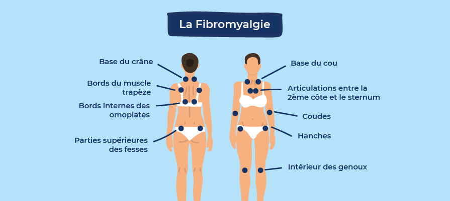 Fibromyalgie