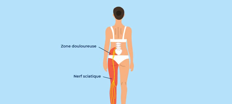 Sciatique et sommeil