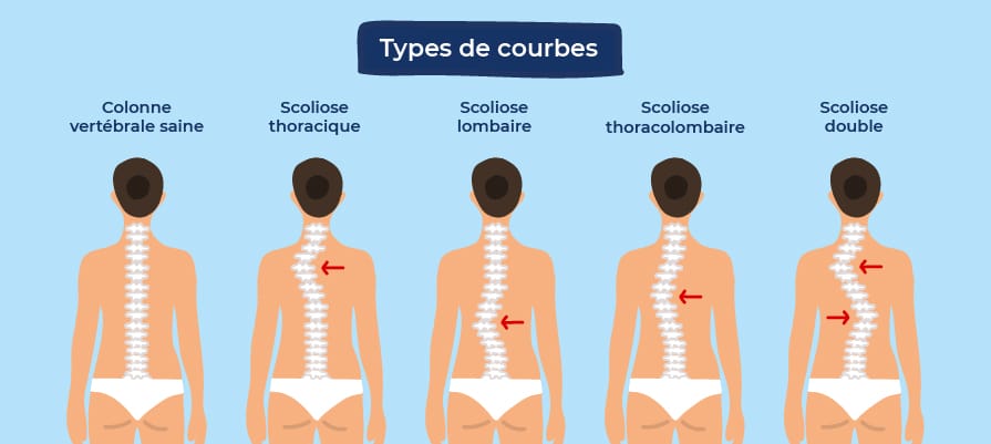 Scoliose : symptômes, causes et solutions -
