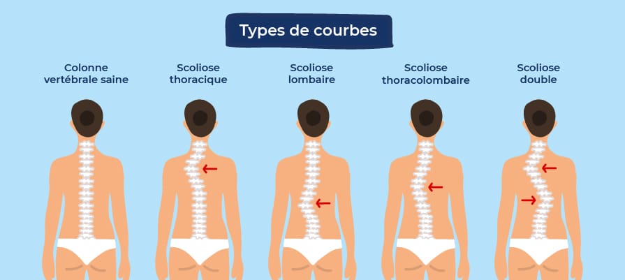 comment soulager votre scoliose pendant la nuit afin d'avoir un sommeil plus réparateur