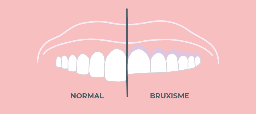 bruxisme