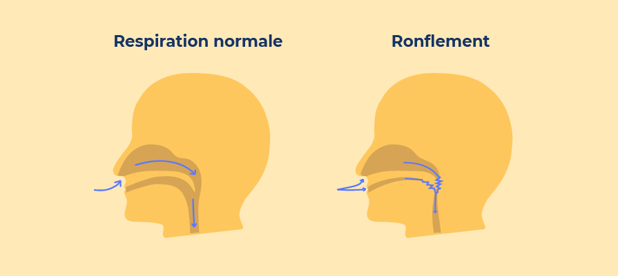 Opération anti-ronflement : le guide pour choisir - Le Mag du Sommeil