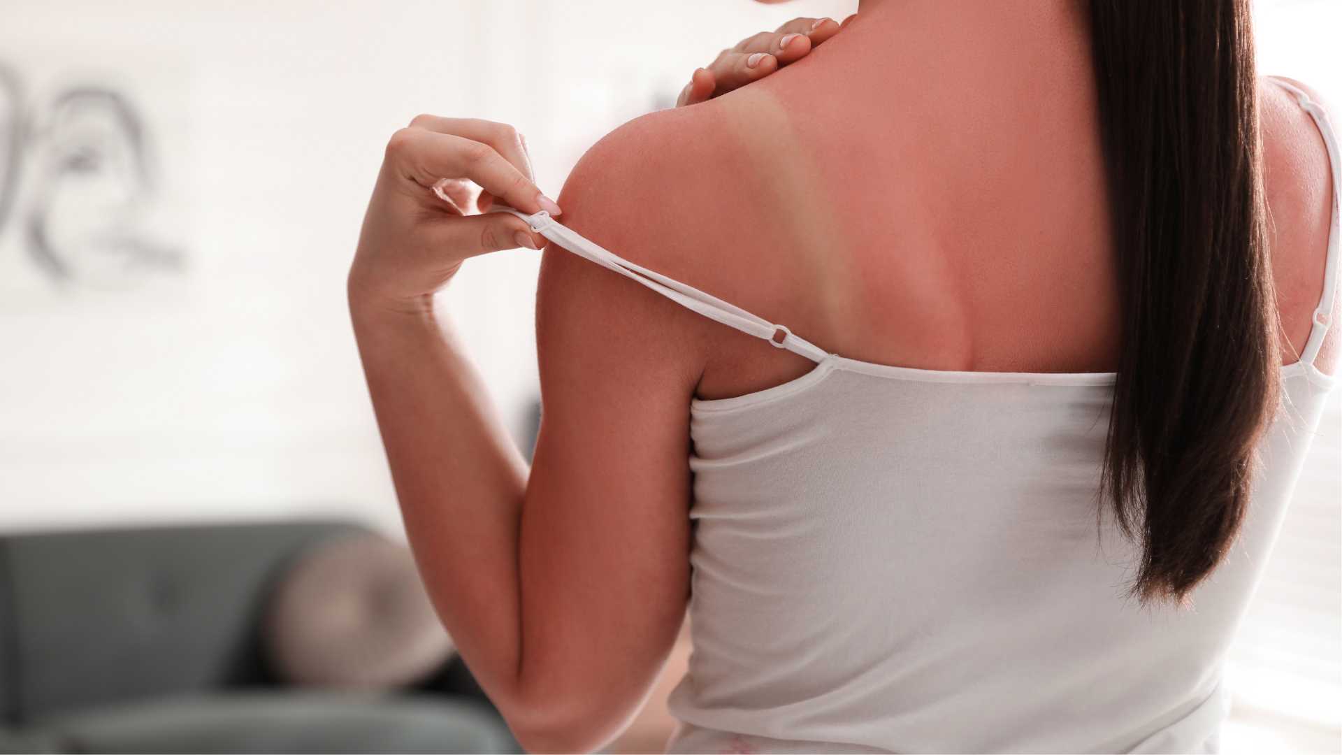 Les astuces pour mieux dormir avec un coup de soleil