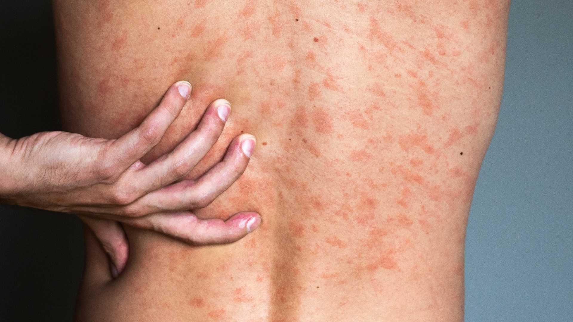 Comment mieux dormir avec de l’urticaire ?