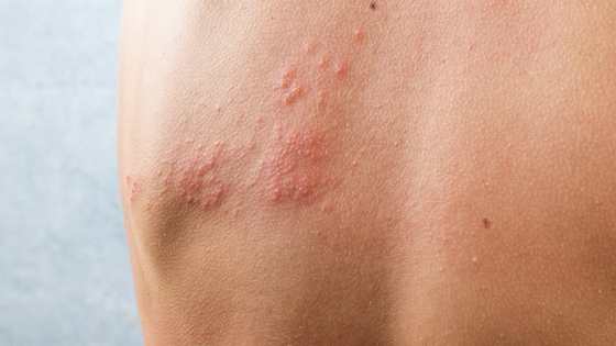 Comment passer une nuit paisible lorsque l'on a de l'urticaire ?
