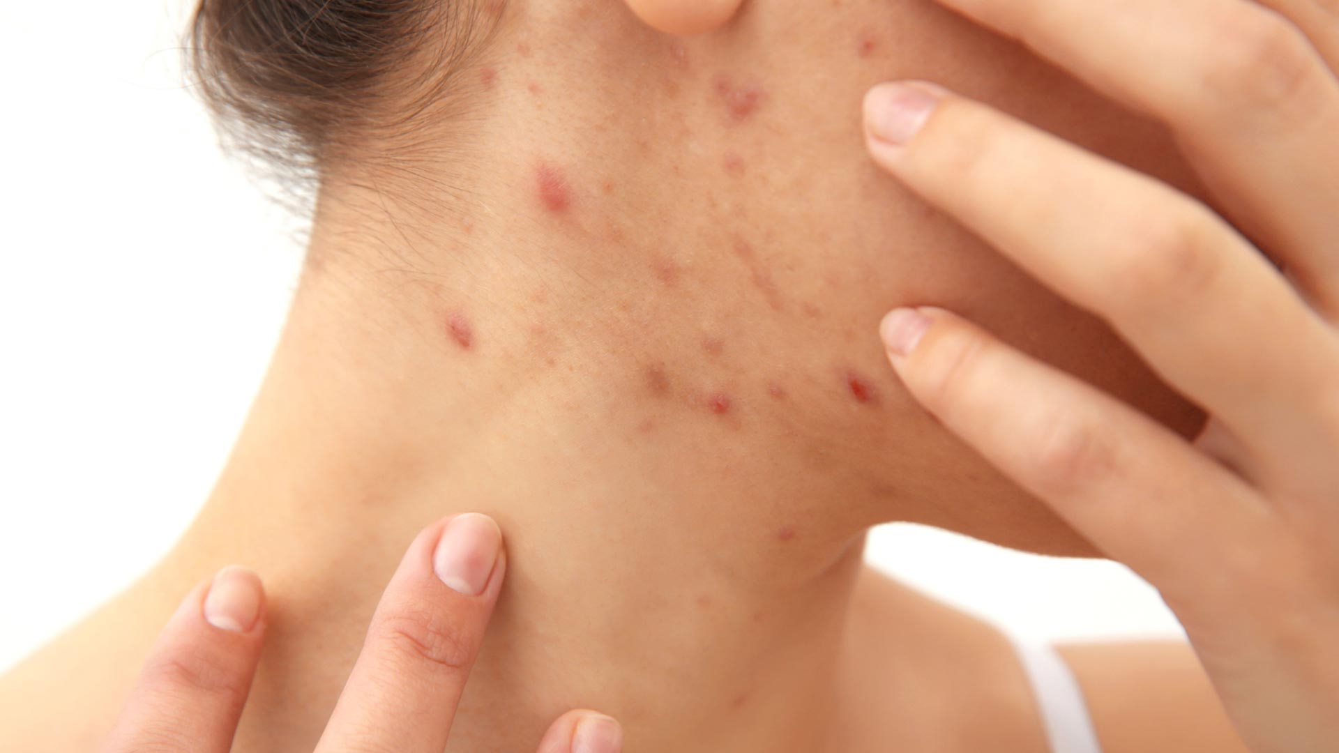 Quels sont les liens entre le sommeil et l’acné ?